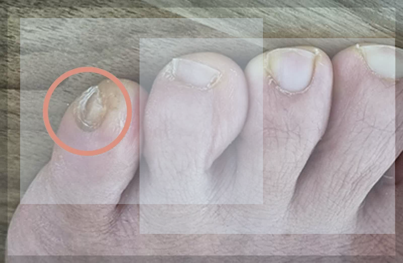 새끼발가락 내성 발톱