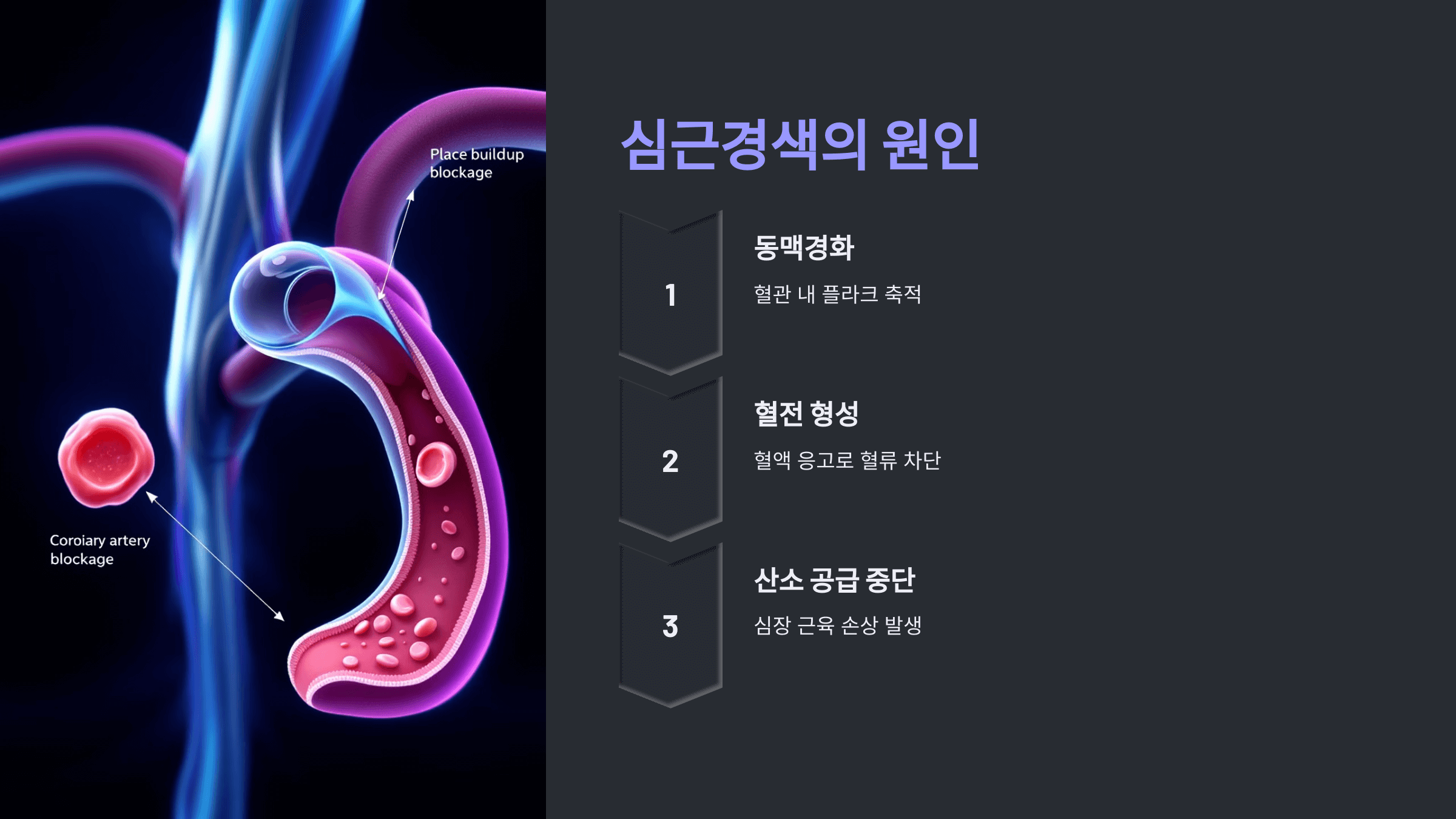 심근경색과 관련된 사진입니다.