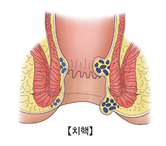 치핵 출처 서울 아산 병원 홈페이지