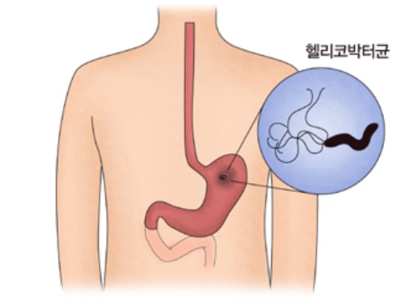 헬리코박토 감염원인 발생경로 치료법