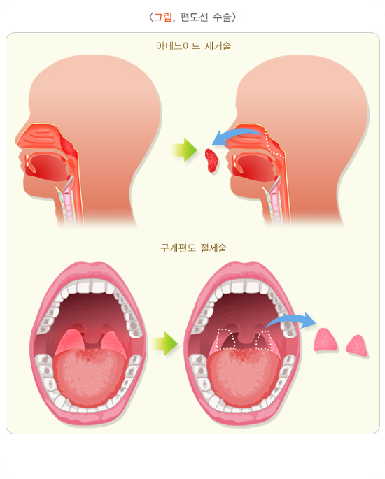 편도선염