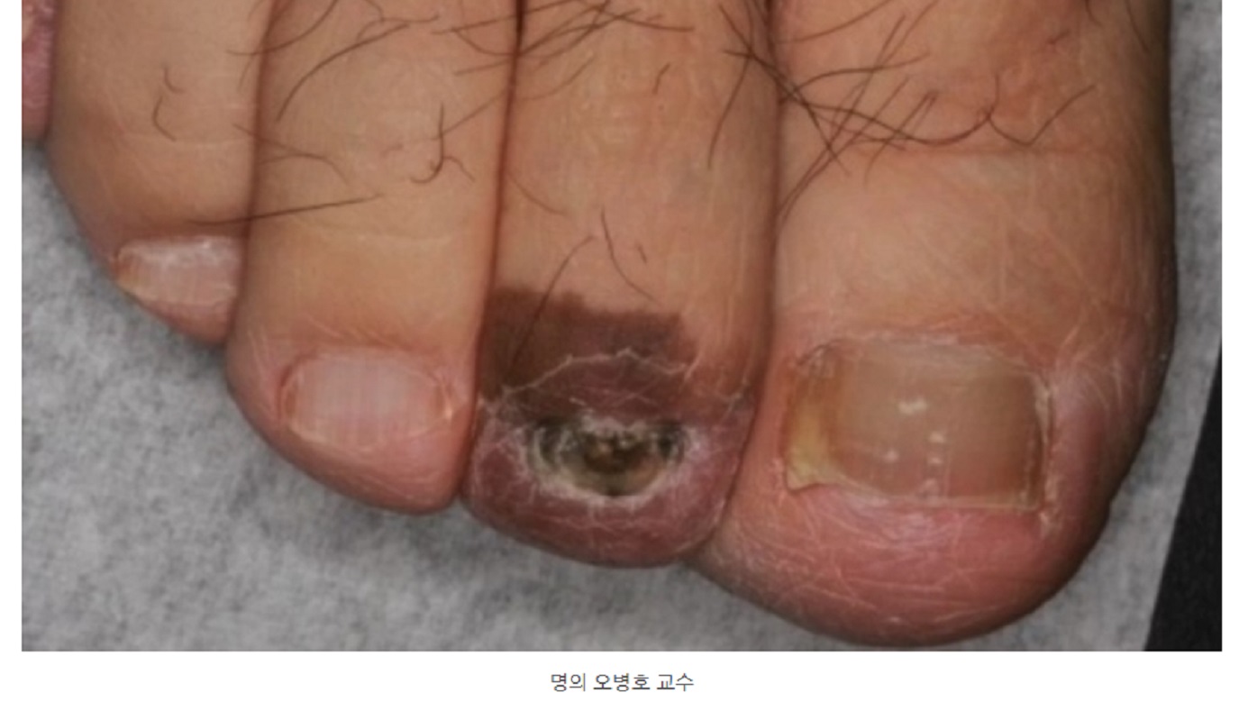 피부암-흑색종-피부과-오병호-교수