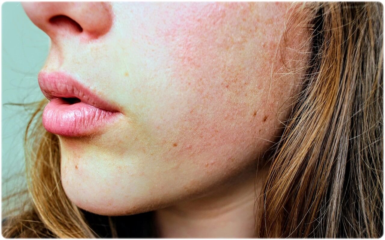 피부암 초기증상 원인 종류 진단 및 치료 방법 예방 방법