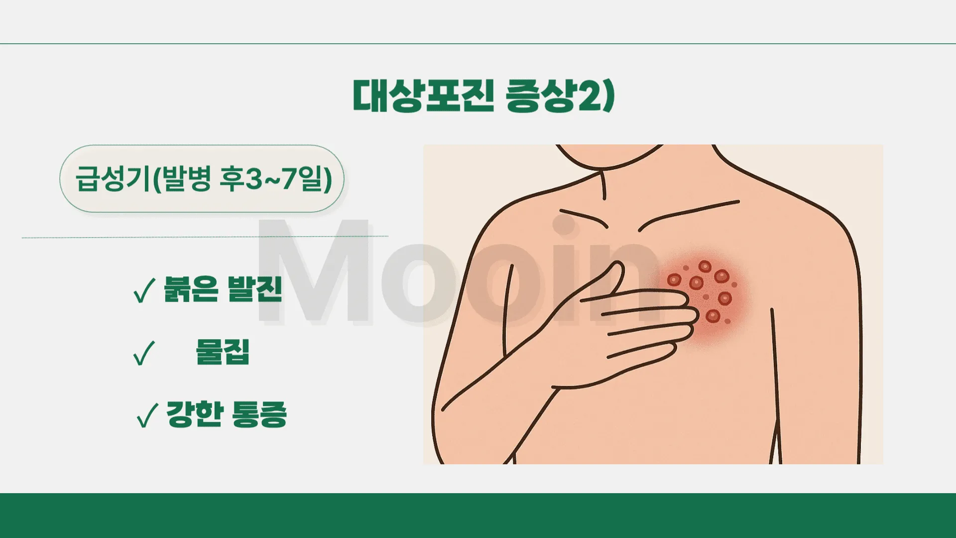 대상포진 증상2)