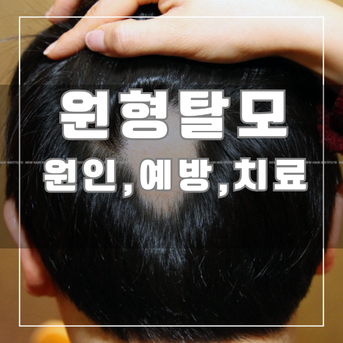 원형탈모 원인 예방 치료법