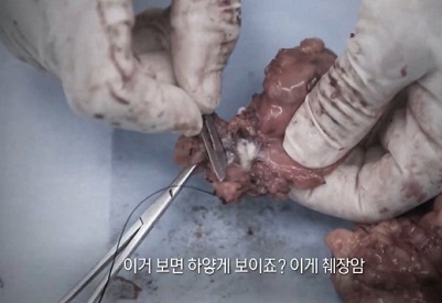 췌장암수술