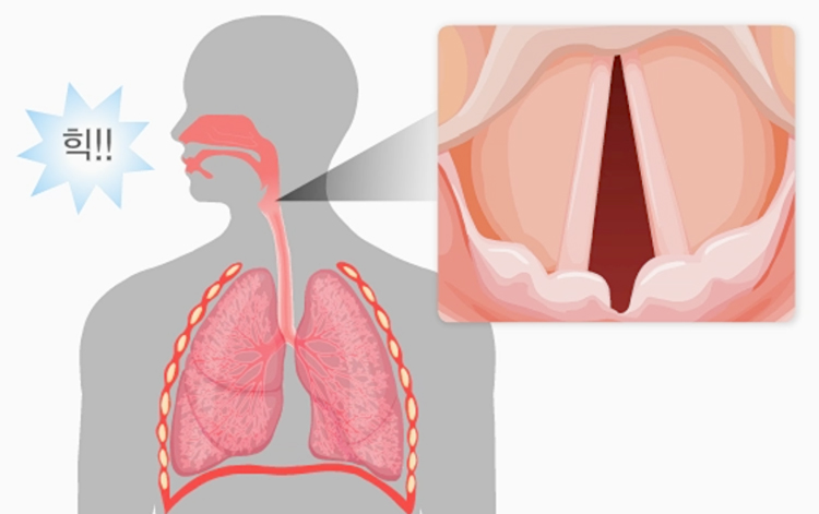 딸꾹질 증상 설명