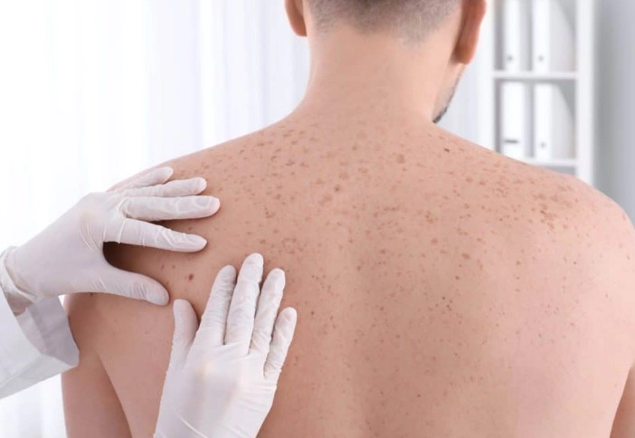 피부암 종류별 초기증상 10가지