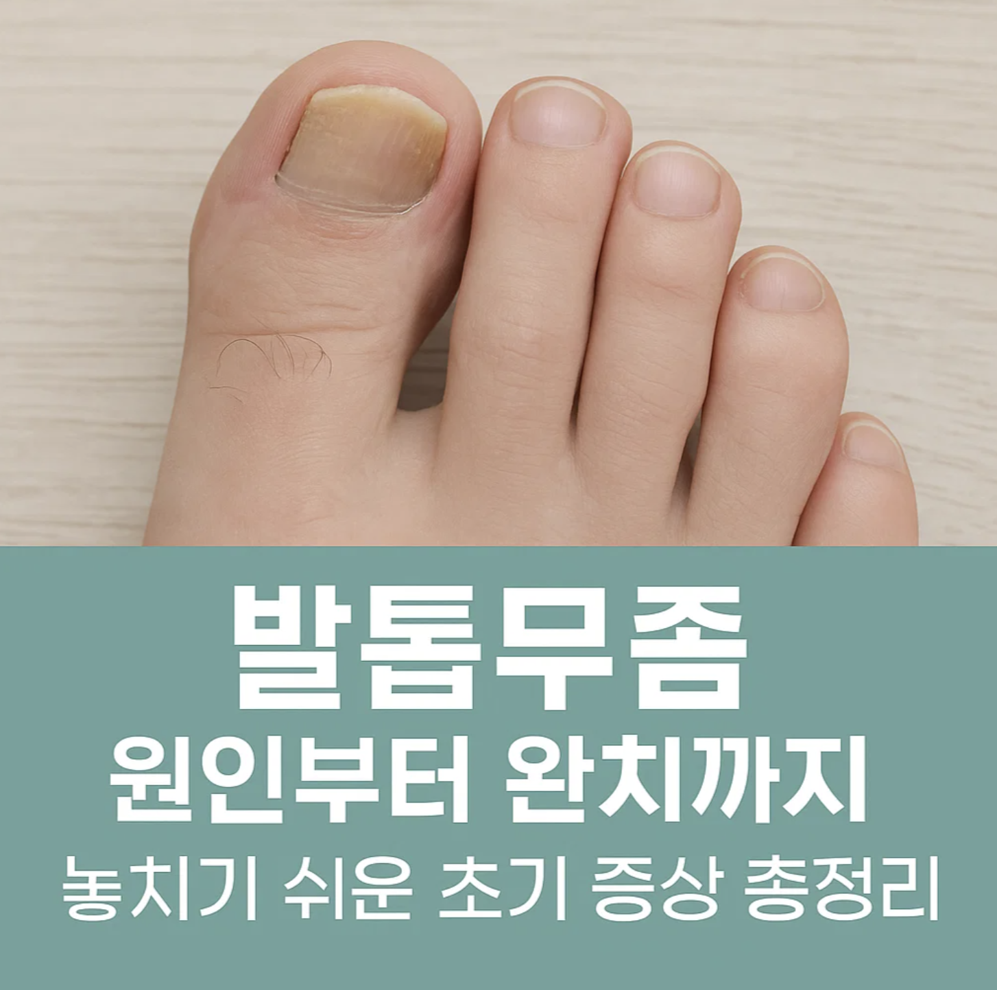 발톱무좀 원인부터 완치까지, 놓치기 쉬운 초기 증상 총정리