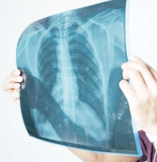 폐섬유화 증상과 원인, 초기 치료법은?