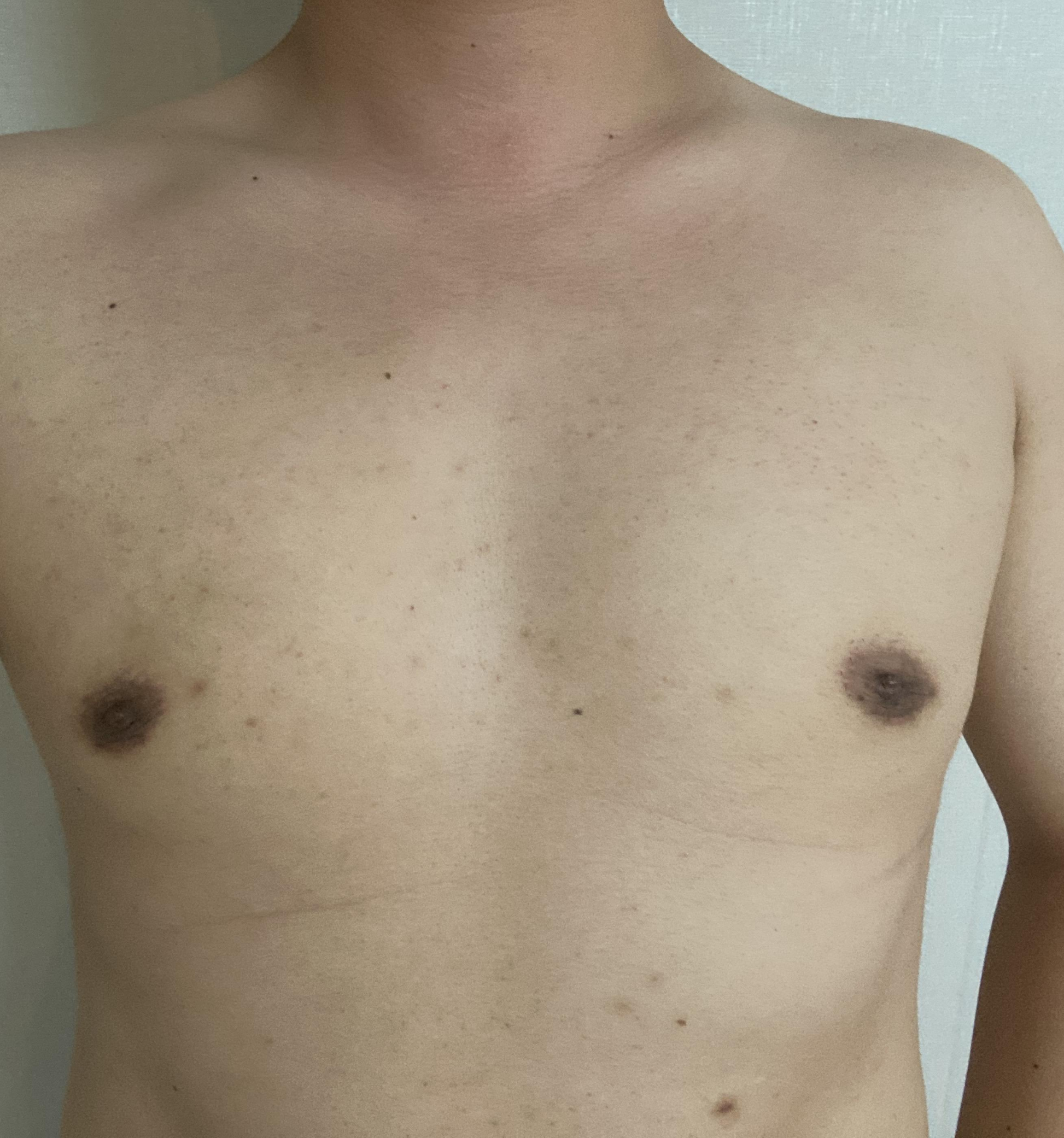 수술 5주 후 앞 모습