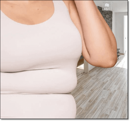 고도 비만 여성