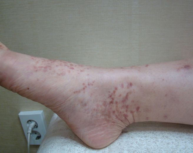 자반증 초기증상