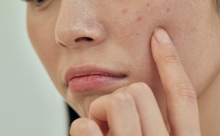 여드름 원인 및 종류