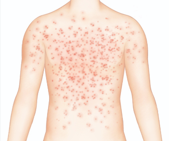 홍역 증상 완벽 가이드