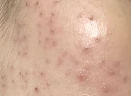 편평사마귀 없애는 방법