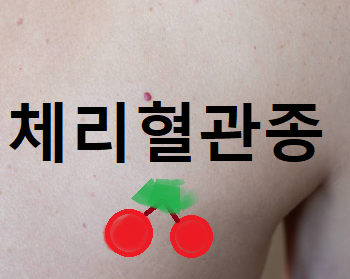 체리혈관종