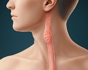 식도암 초기증상