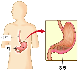 명의 위암 증상 예방 식품 식습관 생존율