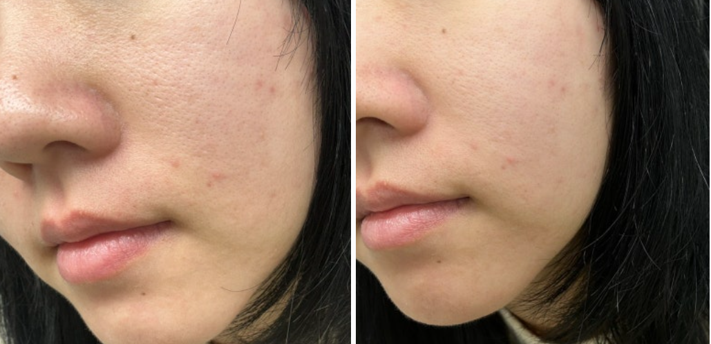 보나메두사 프라이머 효과