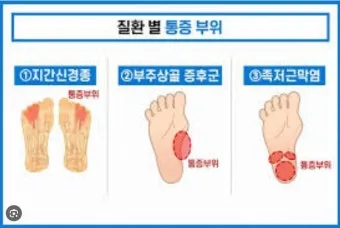 발바닥통증의 원인들과 해결책_2