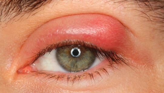 눈꼽이 잘 끼는 이유, 유난히 많이 생기는 원인