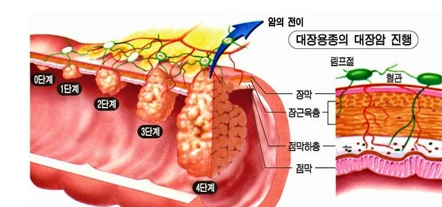 대장암-진행단계