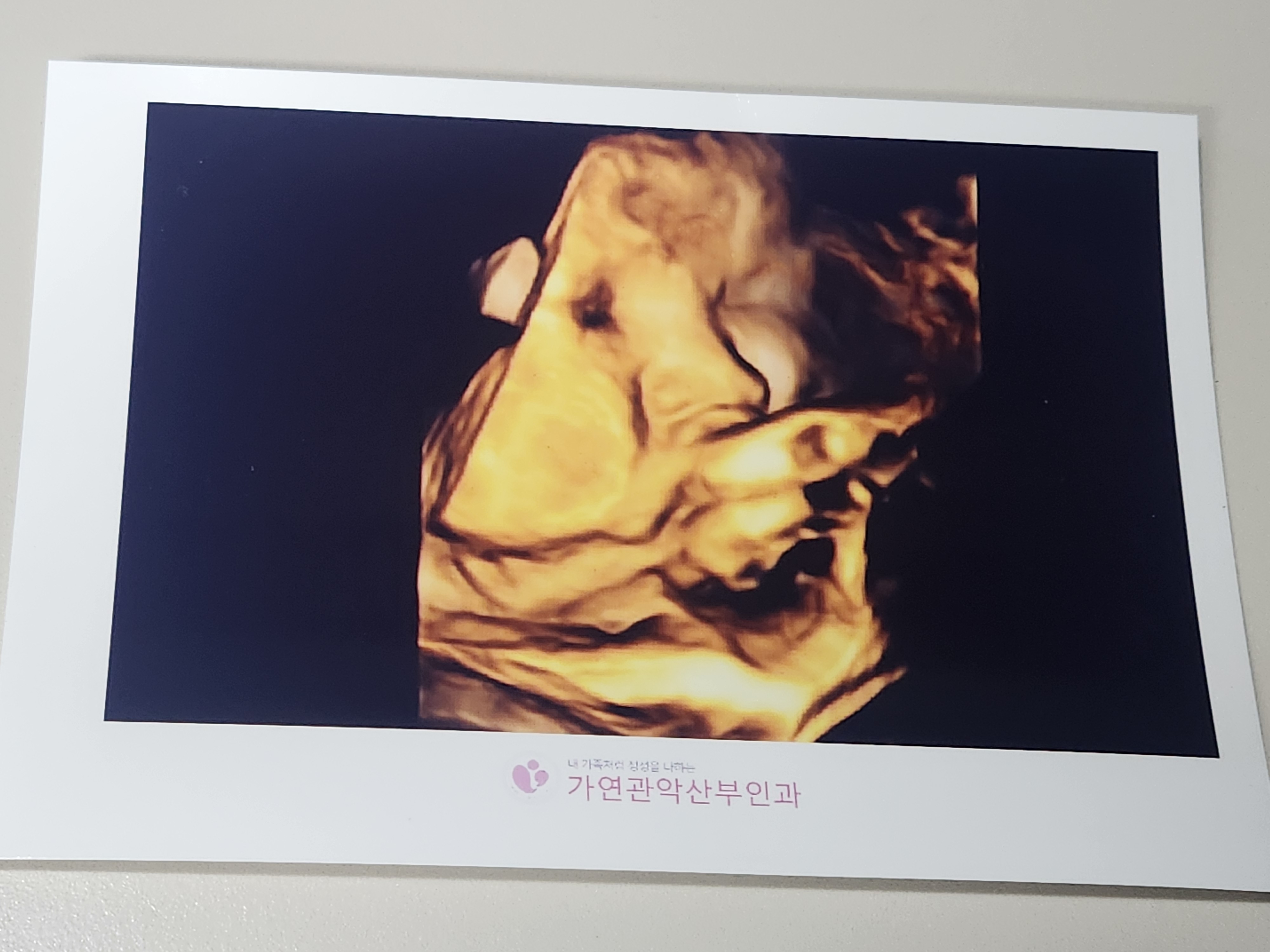 37주 초음파사진