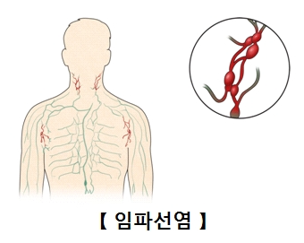 임파선염
