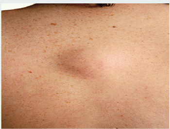 발바닥 섬유종 치료