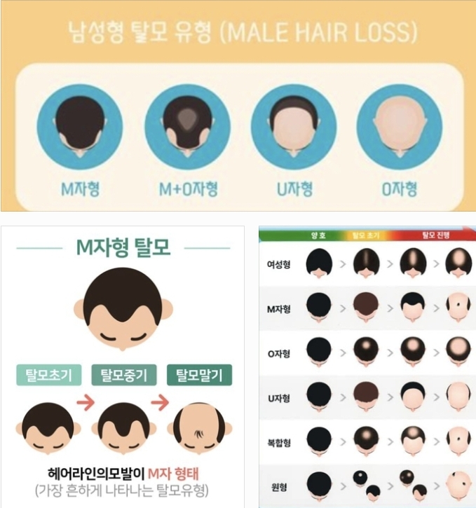 탈모 유형에 대한 사진