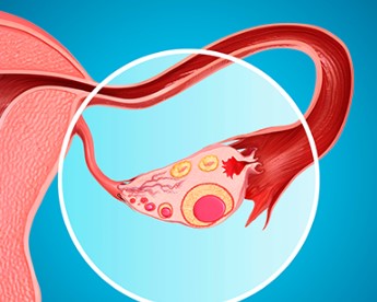 난소 혹 크기 8센치 5센티 증상 | 난소혹 난소암 차이 및 검사 방법