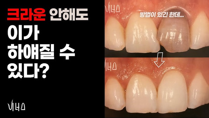 기미 없애는 방법
