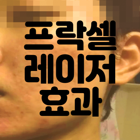 여드름 흉터가 심해 프락셀 레이저 효과가 필요한 남성