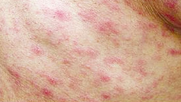 쯔쯔가무시 발진