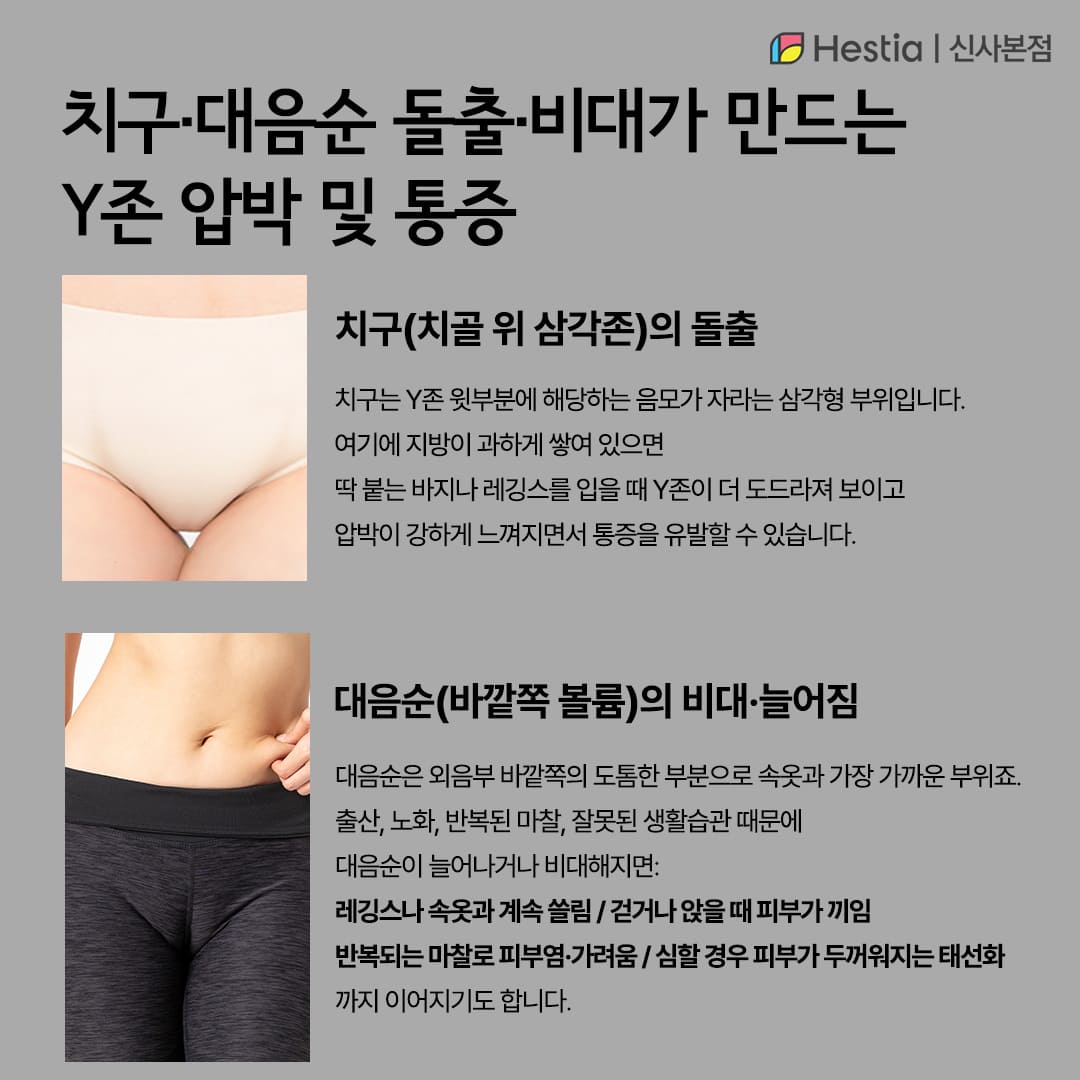 치구&middot;대음순 돌출&middot;비대가 만드는 Y존 압박 및 통증