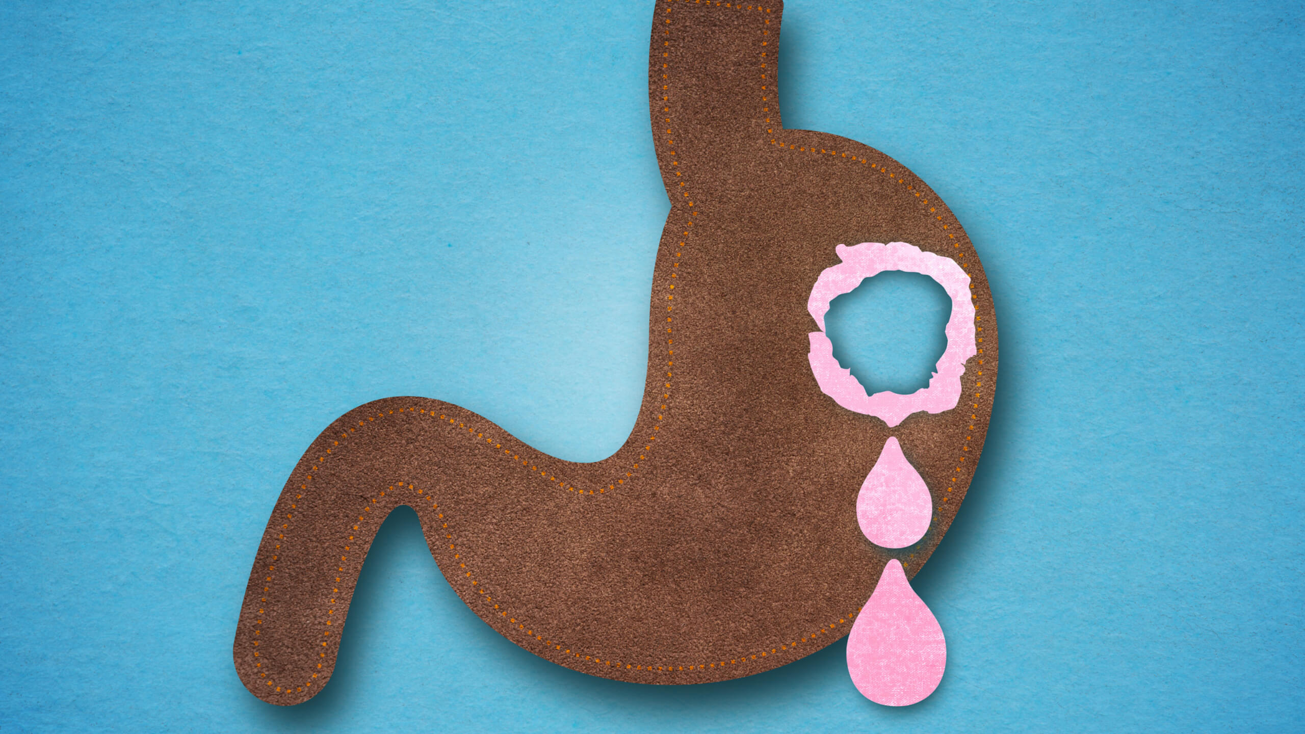 위궤양을 완화하고 헬리코박터균을 억제하는 양배추