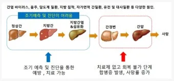 비알콜성 지방간 없애는 방법 운동 식단 중심 회복법 정리_7