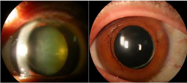 백내장 수술비용