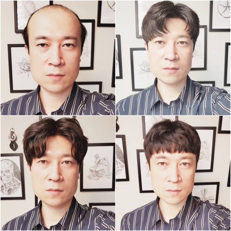 이건뭐고 탈모 성지 모발이식 헤어라인 교정 전문 병원, 맞춤 가발, 부분가발, 항암가발, 정수리가발 추천