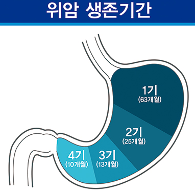 위암 증상