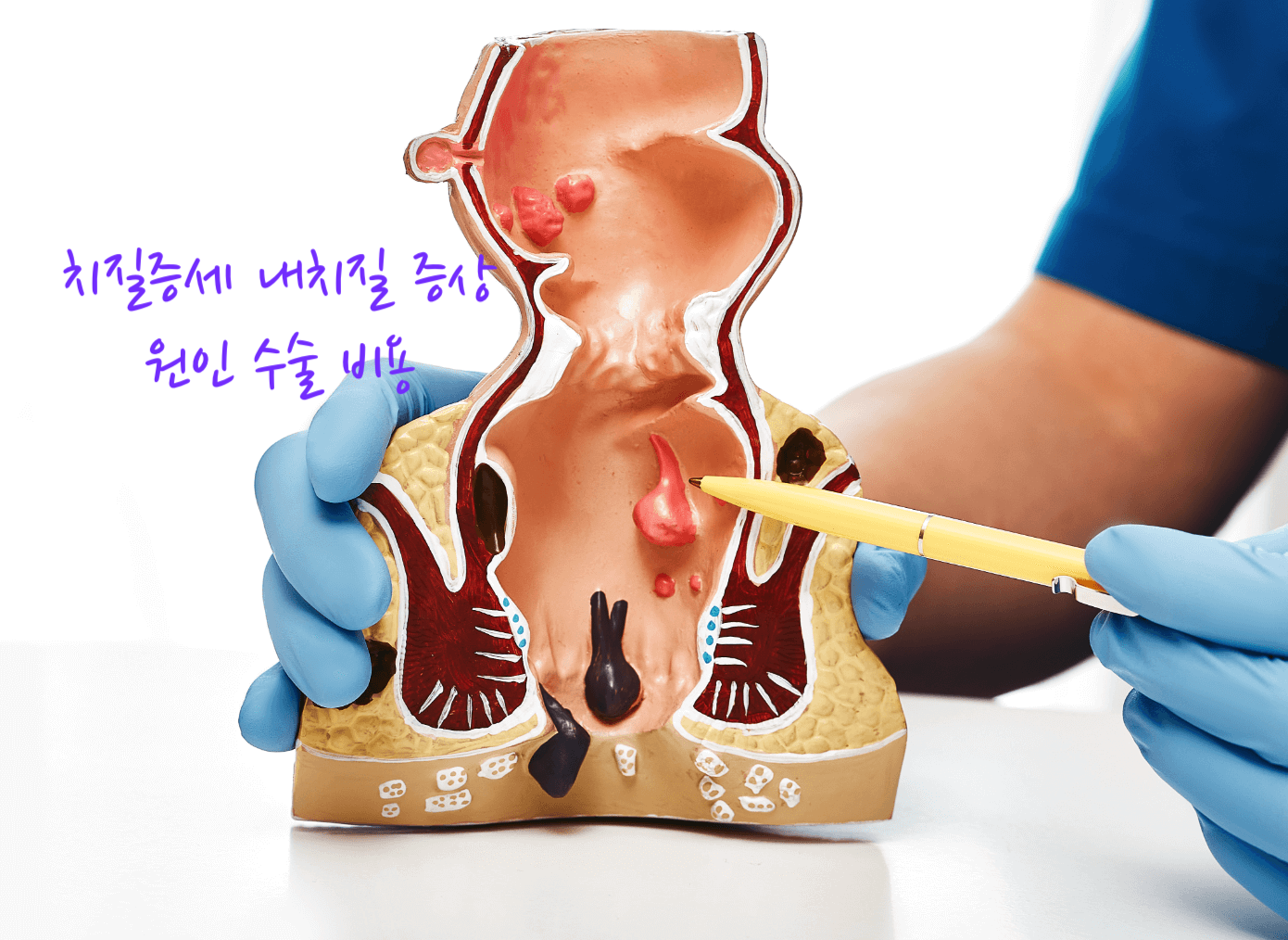 치질증세