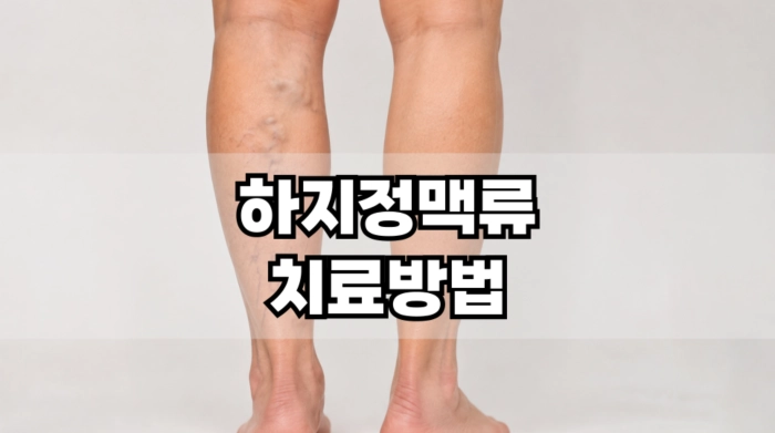 하지 정맥류 치료방법