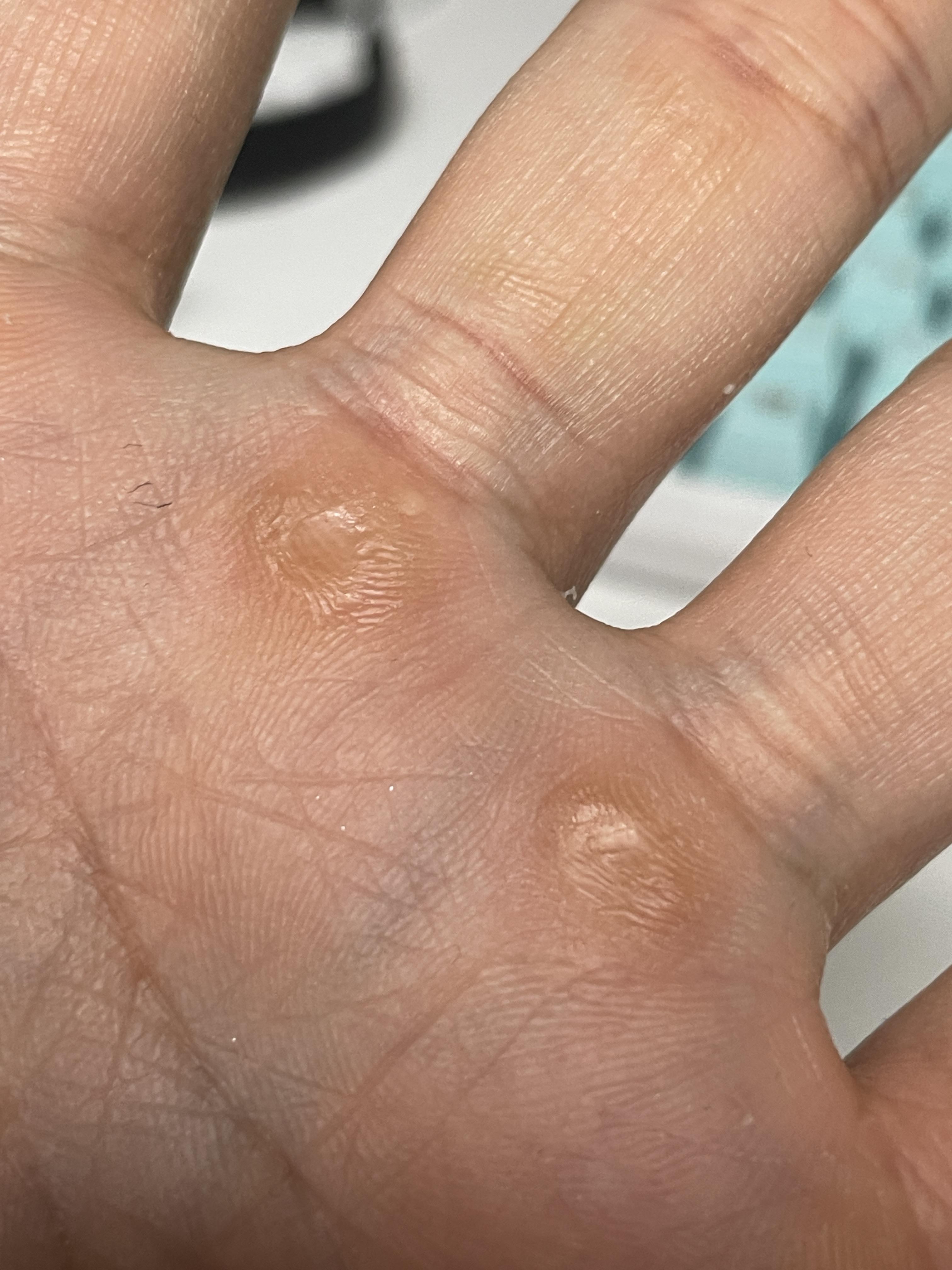 손바닥 굳은살 제거 