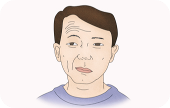 뇌경색-초기증상