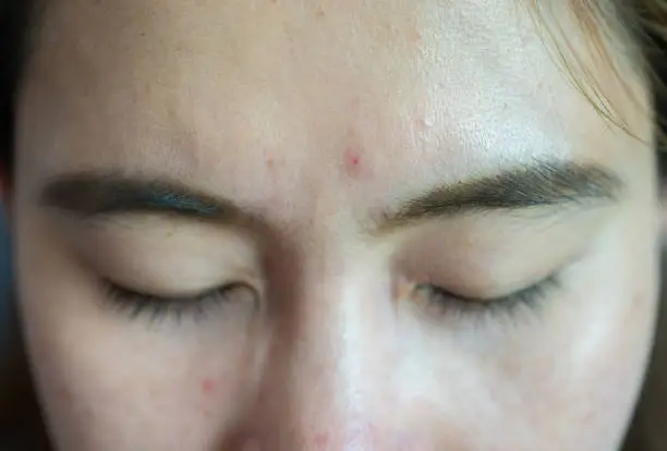 기미 없애는 방법