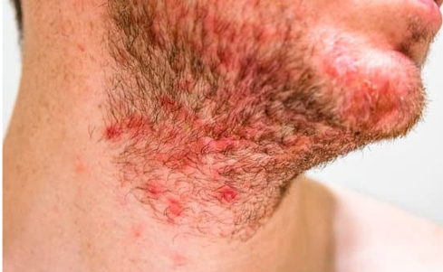 모낭염 원인과 치료방법