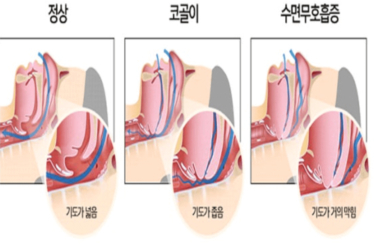 코골이와 수면 무호흡증 차이