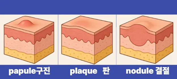 구진 판 결절 피부병소