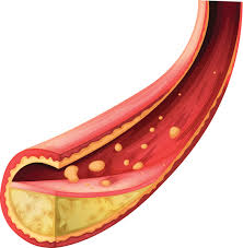 고혈압 낮추는 방법 10가지